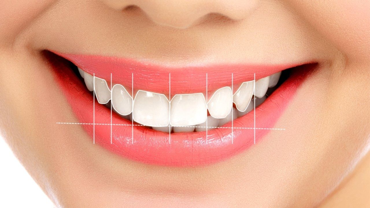 Estetik Diş Hekimliği Gülüş Tasarımı Nedir