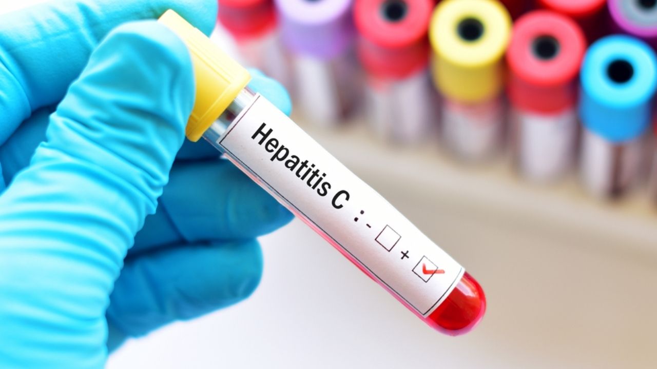 Hepatit Tanımı, Türleri, Nedenleri, Belirtileri ve Tedavi Yöntemleri