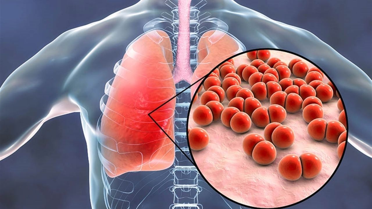 Zatürre Nedenleri, Belirtileri, Tedavi Yöntemleri ve Korunma Yolları